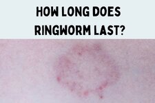 how-long-ringworm-lasts.jpg