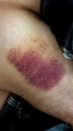 642 bruise.JPG