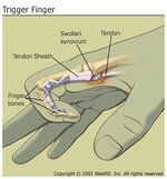 arthritis-trigger-finger_trigger-finger.jpg