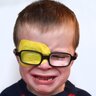 amblyopia